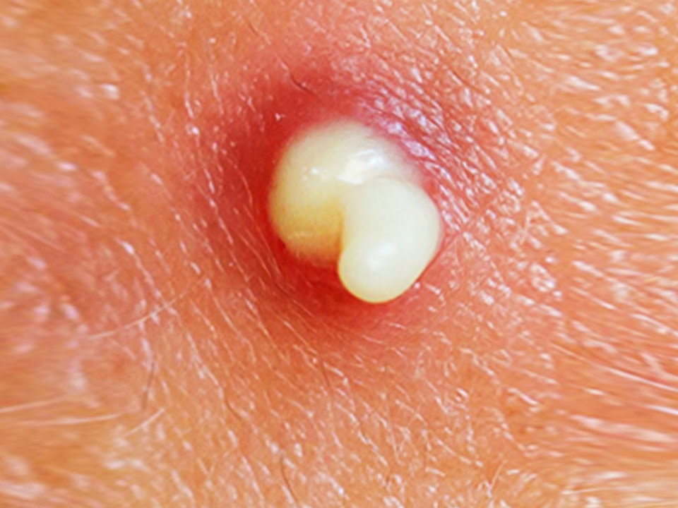 Popping Pimple2