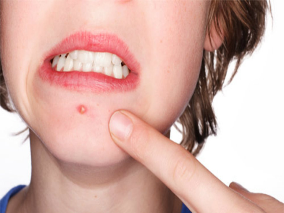 Popping Pimple