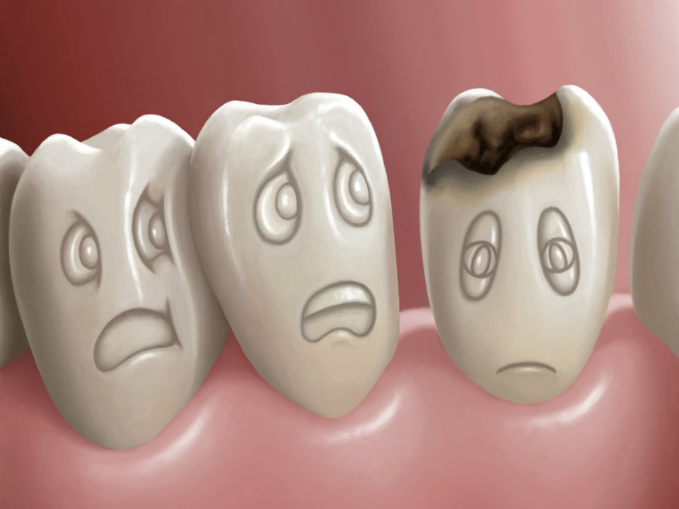 Tooth Decay